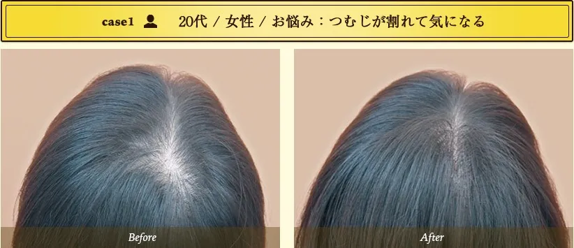 case1・20代/女性/お悩み:つむじが割れて気になる
